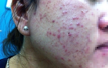 Mỹ phẩm dỏm tàn phá dung nhan