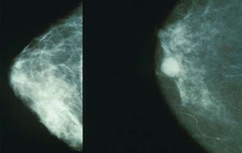 Liệu pháp “bỏ đói” tế bào ung thư vú