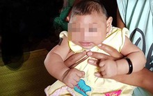 Bé gái 4 tháng tuổi ở Đắk Lắk bị dị tật do virus Zika