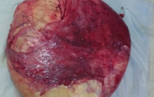 Cắt khối u nặng 32 kg nằm trong bụng bệnh nhân