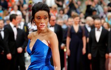 Người mẫu bạch biến tự tin khoe dáng tại Cannes 70