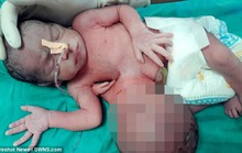 Bé gái có chiếc đầu thứ hai nằm ở… dạ dày