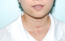 Nhiễm virus HPV, sinh viên 23 năm mang ống thông ngay cổ