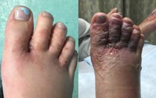 Trả giá đắt vì đi chân trần trên bãi biển