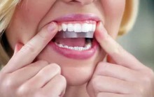Có nên làm trắng răng thần tốc bằng miếng dán?