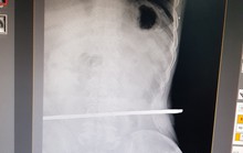 Trượt ngã, cụ ông bị  cọc sắt đâm xuyên hông