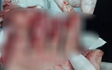Vào viện với thùng lạnh đựng nhiều ngón tay