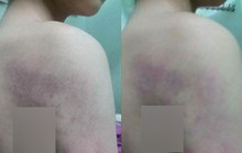 Cô giáo muốn giải quyết nội bộ sau khi bị tố đánh học sinh lớp 1 thâm tím người
