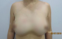 Rút cả lít silicon thông khe giữa ngực người phụ nữ