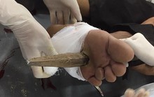 Xà beng trên trời rơi xuống xuyên thấu chân người đàn ông