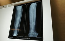 Yêu cầu kỳ lạ, người phụ nữ gãy chân bị nhiều bệnh viện từ chối