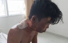 Lí do khiến chị gái đổ nước sôi lên người em trai gây bỏng nặng