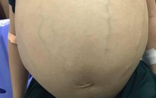 Người phụ nữ đau khổ với khối bướu khổng lồ sắp phát nổ ở bụng
