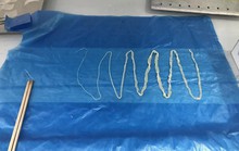 Người đàn ông 10 năm sống chung với sán dây dài 2m