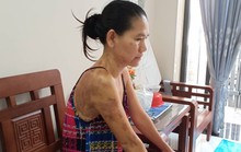 CLIP Nạn nhân kể giây phút kinh hoàng bị tạt chảo dầu đang sôi vào người