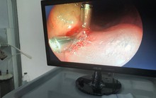 15 phút dùng 2 clip kẹp cứu bệnh nhân có tá tràng chảy máu thành dòng
