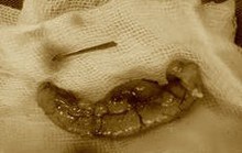 Người đàn ông thủng ruột thừa vì thói quen ngậm tăm
