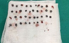 Nhặt gần 40 viên đạn găm trên mặt cho nam thanh niên
