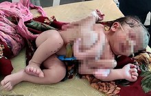 Bé gái chào đời với bốn chân và ba tay ở Ấn Độ