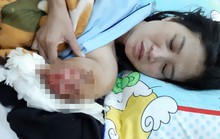 Mổ lần 2 cho cô giáo chạy 130km bị tai nạn phải cắt bỏ cánh tay