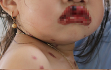 Bé gái 3 tuổi mắc chứng bệnh lạ khiến lở loét toàn bộ 2 môi