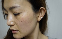 Vì sao phụ nữ Việt lại dễ bị nám?