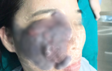 Nữ công nhân ở Bình Dương bị u máu ăn nửa mặt được phẫu thuật miễn phí