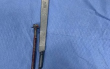 Người đàn ông đến bệnh viện với chiếc ốc vít dài 6cm xoáy vào giữa dương vật