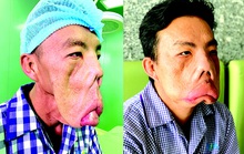 Kỳ tích cứu chàng mặt quỷ
