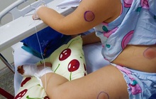 Phát hiện 1 bé gái ở Quảng Bình nhiễm vi khuẩn ăn thịt người
