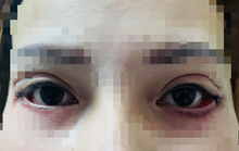 Cô gái trẻ suýt bị mù sau khi... cắt mí mắt