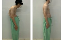 5 giờ đục xương cứu chàng trai còng cột sống do tai nạn giao thông