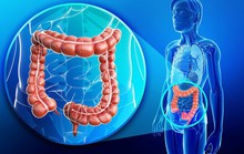 Phát hiện sớm ung thư đại trực tràng bằng công nghệ mới