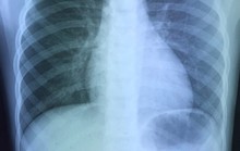 Bé gái 6 tuổi suýt tắt thở vì nuốt phải đồng xu