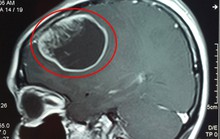 Thường xuyên đau đầu, đi khám phát hiện khối u chèn ép não