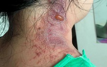 Lở loét, nhiễm thêm độc tố vì nhà thuốc chẩn đoán nhầm