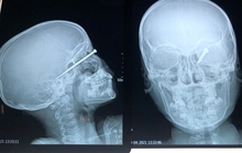 Bé trai 8 tuổi bị mũi tên bắn xuyên mắt, găm sâu vào sọ não