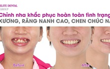 Để có một hành trình niềng răng suôn sẻ, cần lưu ý những điểm sau