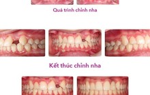 Khi nào cần làm thêm điều trị thẩm mỹ sau niềng răng?