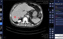 VinBrain cùng Bệnh viện ĐH Y dược TP HCM phát hiện và chẩn đoán ung thư gan bằng AI