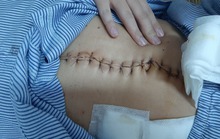 Hai thanh niên bị đâm thủng ruột nguy kịch