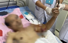 Nối cánh tay đứt lìa cho người đàn ông 50 tuổi