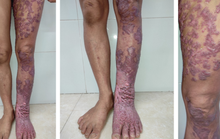 Nhiễm loại nấm da bị lãng quên, chân người phụ nữ sần sùi như vỏ cây