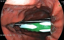 Hi hữu bàn chải đánh răng và ruột bút bi trong dạ dày nam bệnh nhân