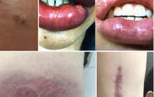 Tiêm filler đội lốt collagen, nhiều người gặp biến chứng