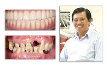 Giải pháp tối ưu trong điều trị mất răng toàn hàm từ nghiên cứu của TS Trần Hùng Lâm