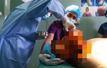 6 giờ nghẹt thở loại bỏ quả bom sắp nổ trên mặt người đàn ông