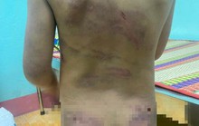 Bé gái mang đầy vết thương gây dậy sóng mạng xã hội ở cùng mẹ và cha dượng