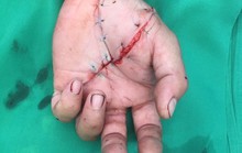 Bác sĩ xuyên đêm nối bàn tay đứt lìa cho nam bệnh nhân