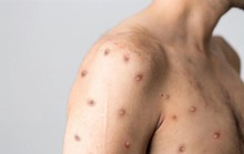 Thêm 2 nước có bệnh nhân đậu mùa khỉ tử vong